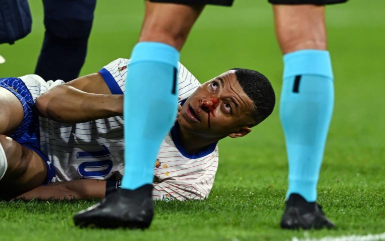 Rottura del naso per Mbappe contro l'Austria